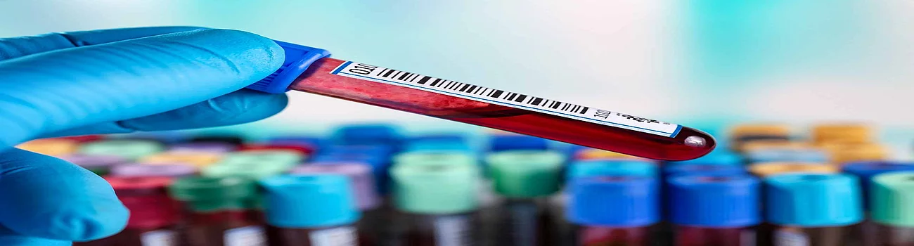 Blood sample for coagulation test in the laboratory