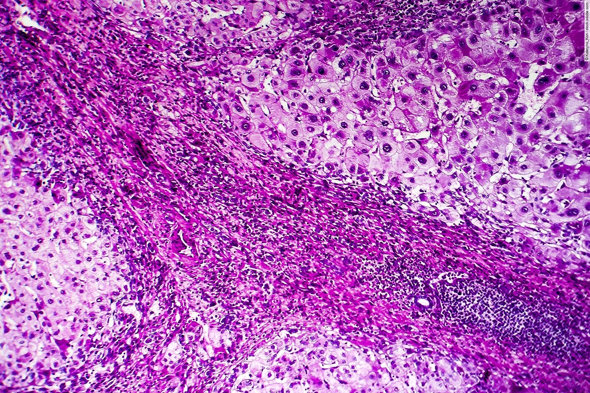 Eine histopathologisches Präparat einer Leberzirrhose unter dem Mikroskop.