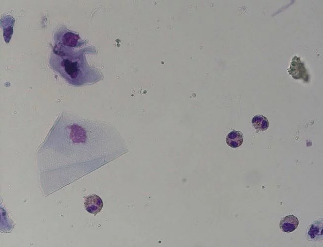 Eosinophile Granulozyten Eosinophile Granulozyten