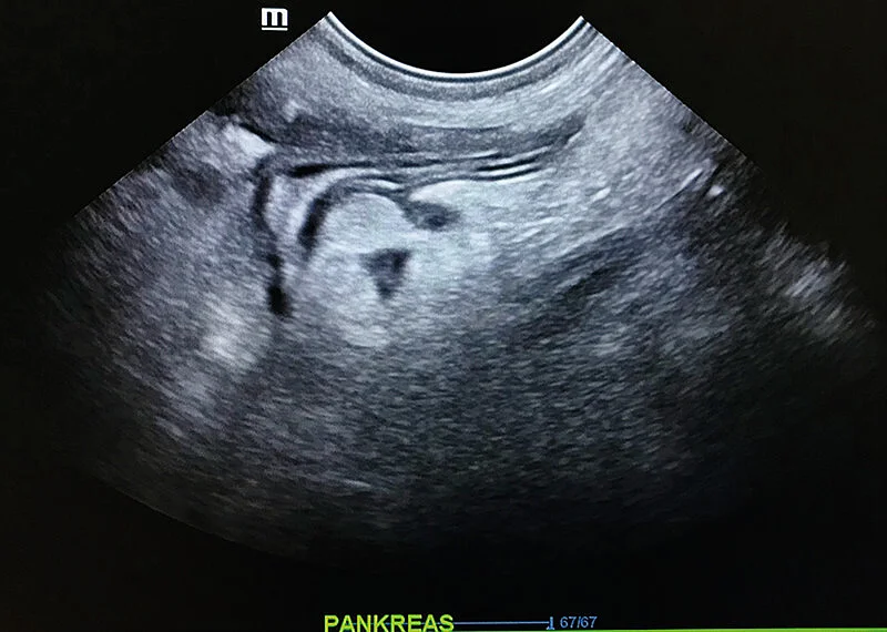 Ein sonografisches Bild des Duodenalschenkels des Pankreas mit umgebenden Mesenterium. Ein sonografisches Bild des Duodenalschenkels des Pankreas mit umgebenden Mesenterium.