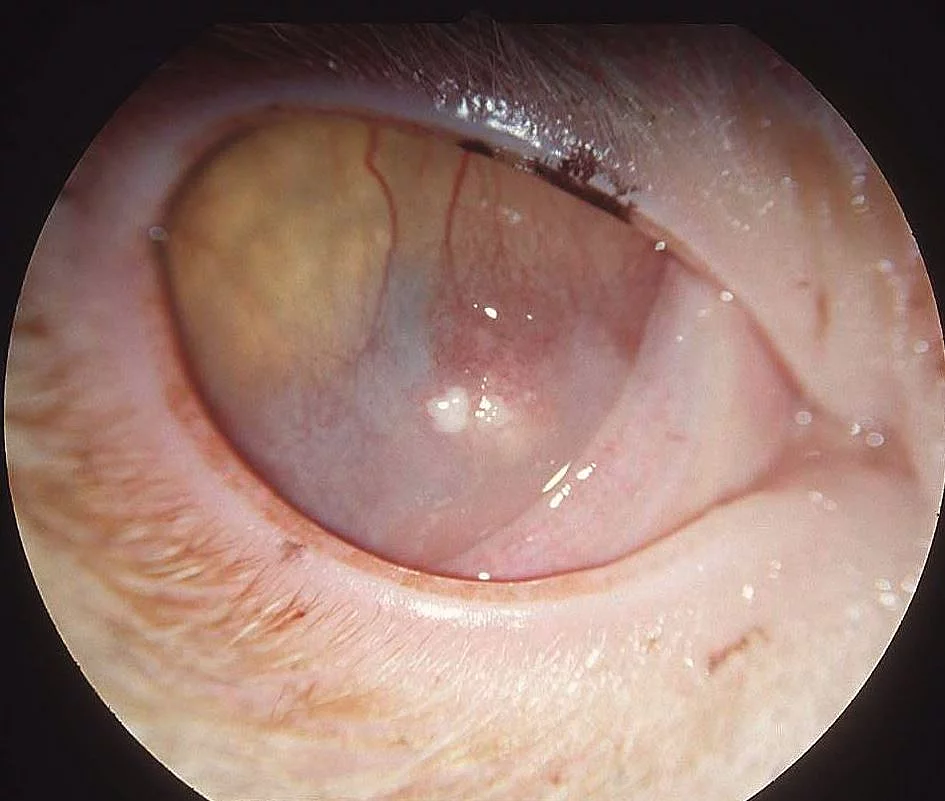 Eosinophile Keratitis Eosinophile Keratitis