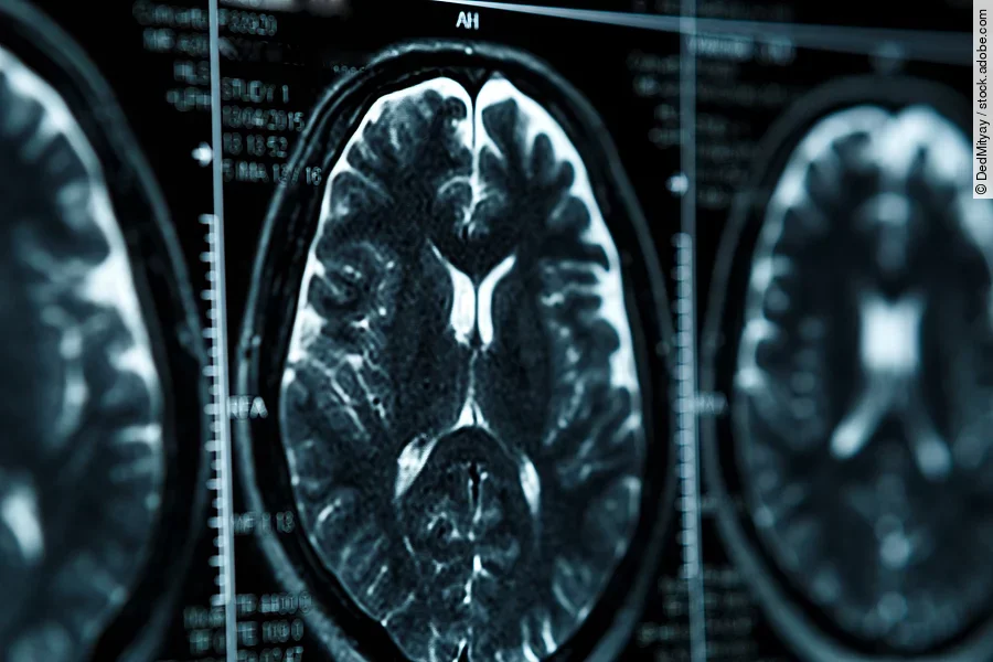 Ein MRT Bild zeigt 3 Aufnahmen eines menschlichen Gehirns.