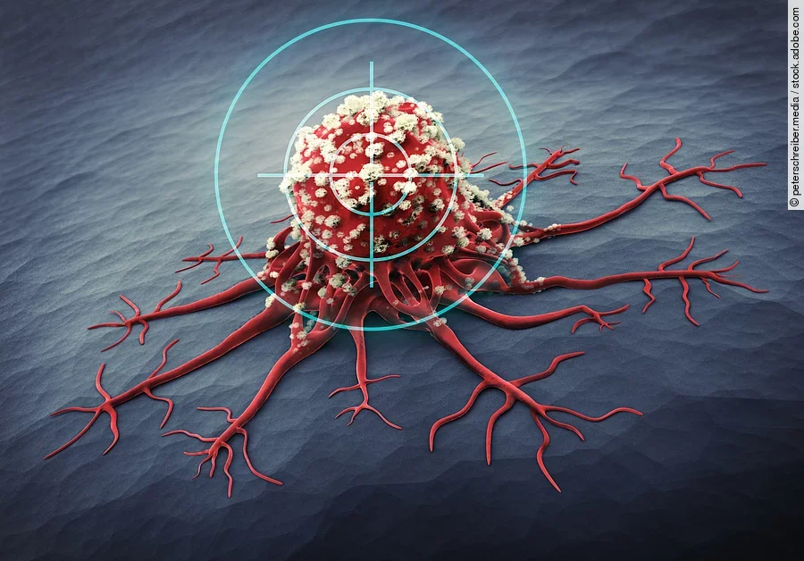 Eine Tumorzelle mit eigenen Gefäßen sitzt fest an der Haut und wird jetzt gezielt bekämpft.