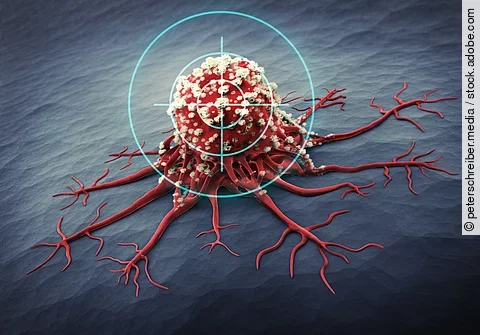 Eine Tumorzelle mit eigenen Gefäßen sitzt fest an der Haut und wird jetzt gezielt bekämpft.