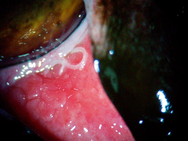 Bei der Augenuntersuchung mithilfe einer Fixierpinzette nach Gräfe konnte Thelazia callipaeda nachgewiesen werden.