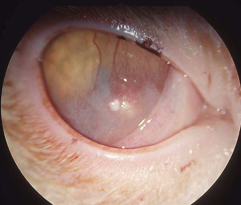 Eosinophile Keratitis