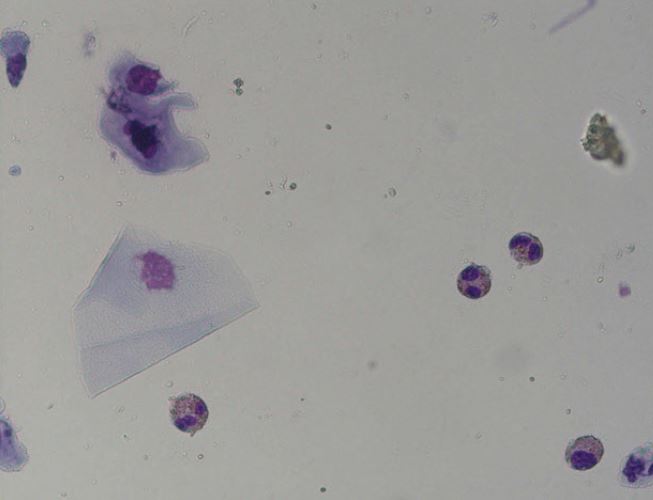Eosinophile Granulozyten