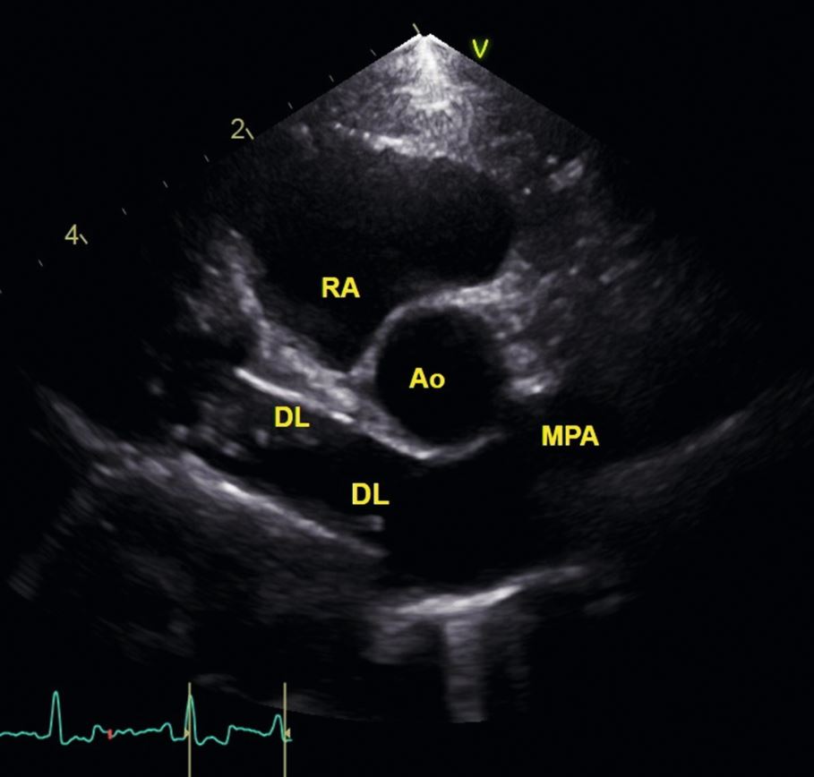 Doppellamellen in der Echokardiografie